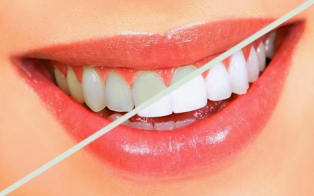 Il pericolo dello sbiancamento dei denti