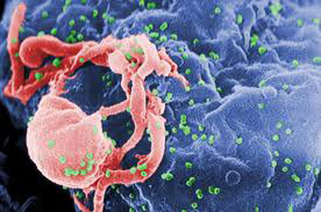 Virus Hiv: scoperto ceppo molto aggressivo a Cuba