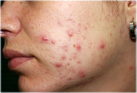 Cura dell’acne: ritiro lotto specialita’ medicinale “ISDIBEN”