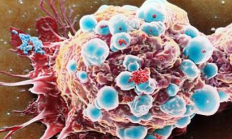 Cancro, studio Usa: contagio virus del papilloma aumenta rischio tumore della testa e del collo di almeno 7 volte