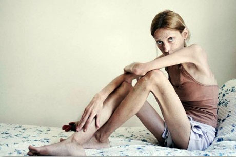 Anoressia, una cura potrebbe ridurre i sintomi