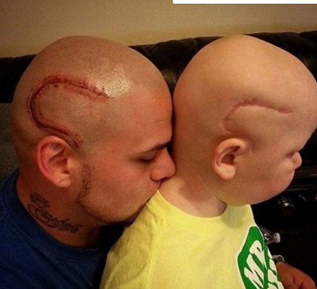 Un tatuaggio per amore. Un padre si è fatto tatuare in testa il segno della cicatrice del figlio Gabriel, operato per un tumore al cervello